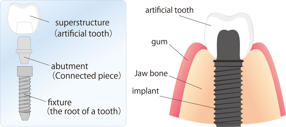 Depositphotos_6046100_original-Implant-Diagram